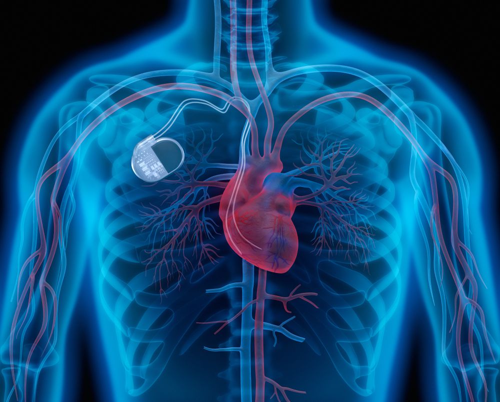 pacemaker-implantation-rays-clinic