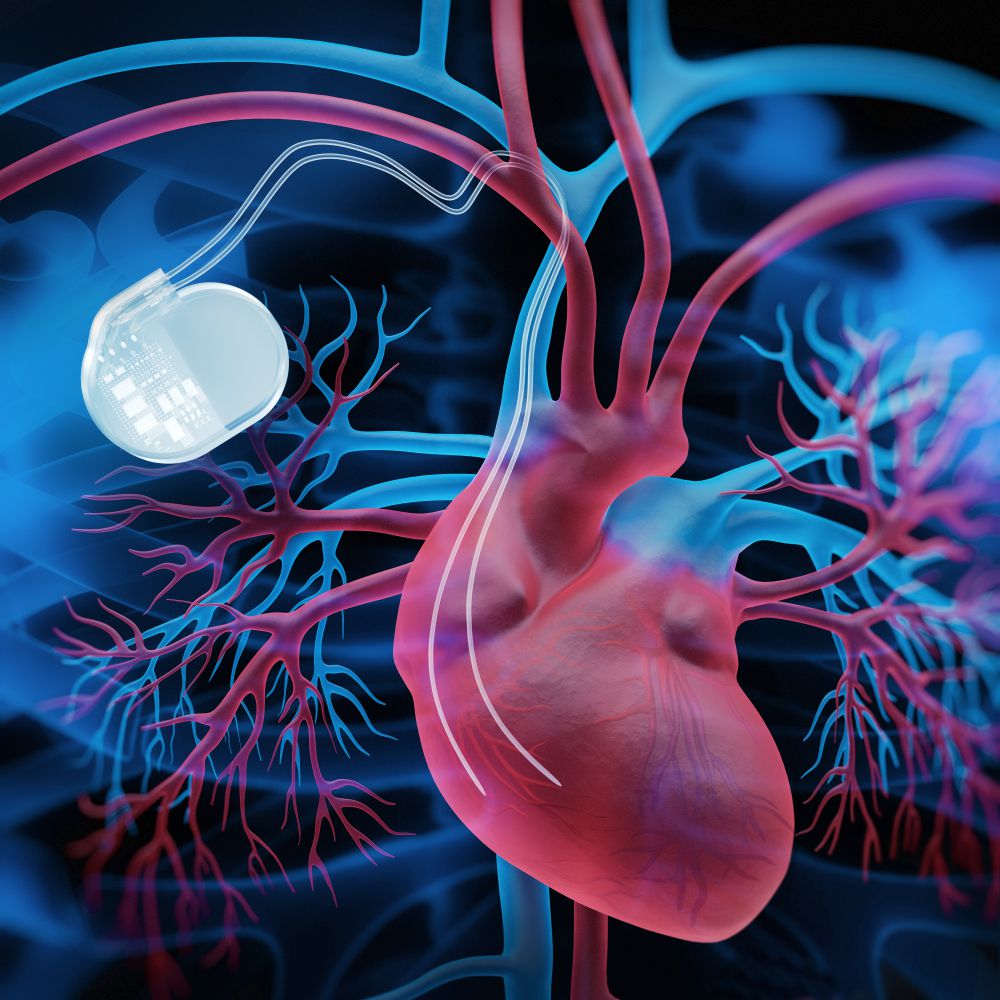 Implantable Defibrillators (ICD)